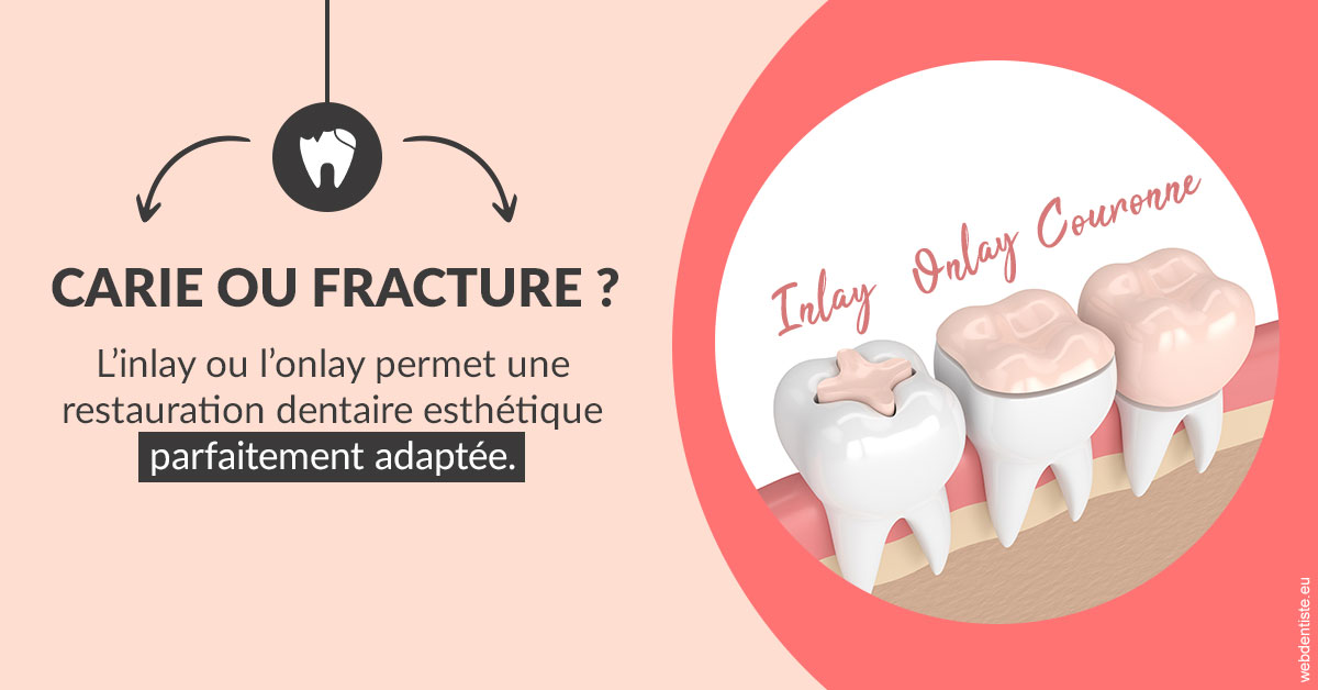 https://www.centre-dentaire-archereau-paris19.fr/T2 2023 - Carie ou fracture 2