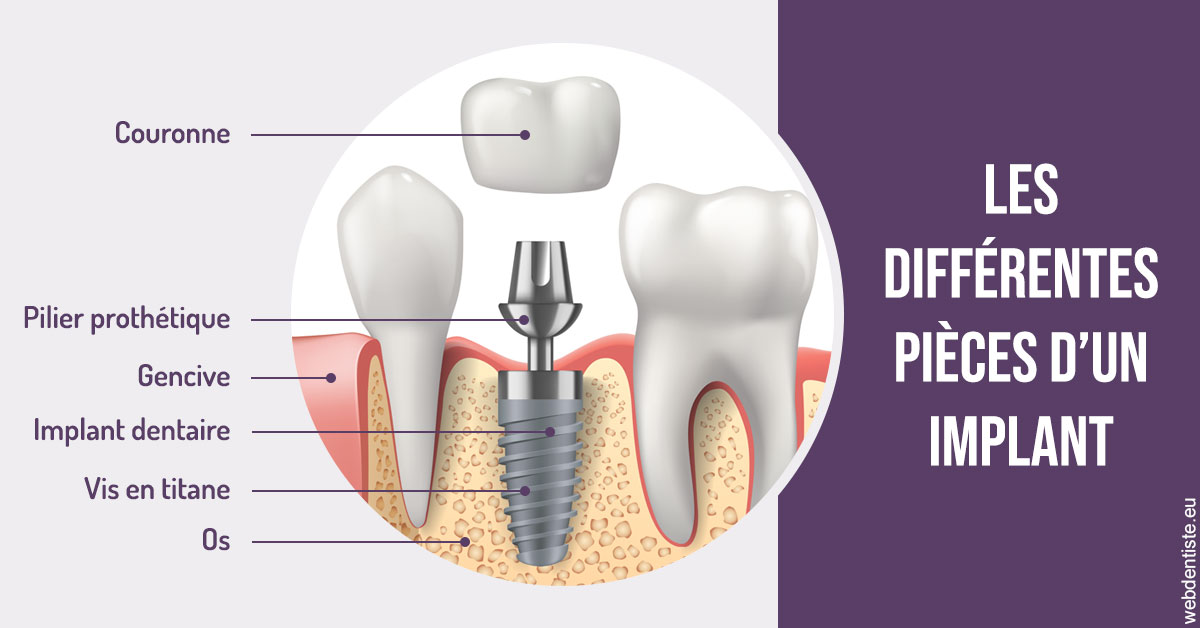 https://www.centre-dentaire-archereau-paris19.fr/Les différentes pièces d’un implant 2