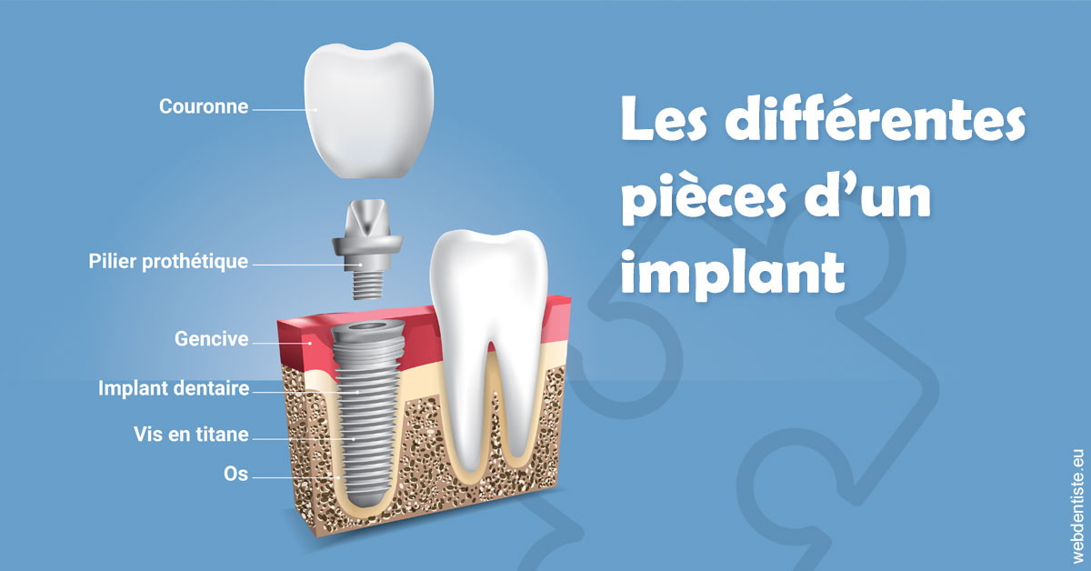 https://www.centre-dentaire-archereau-paris19.fr/Les différentes pièces d’un implant 1